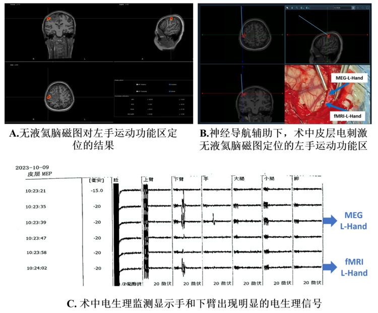 全球首例无液氦脑磁图辅助下的胶质瘤切除手术顺利完成(图1)